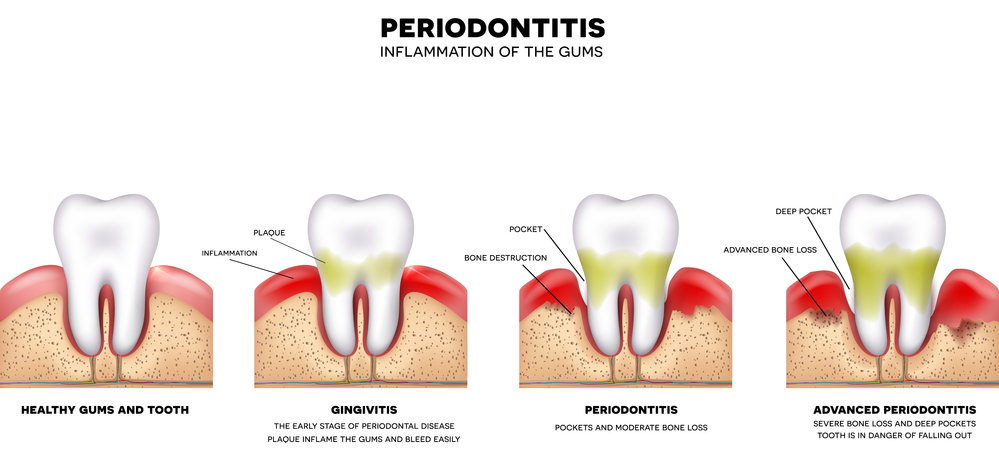 Periodontitis, inflammation of the gums, detailed illustration