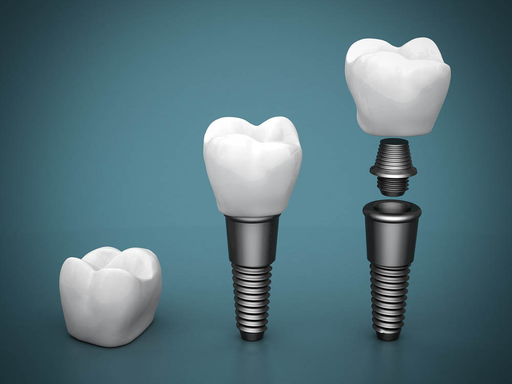 Dental implants on a beautiful blue background