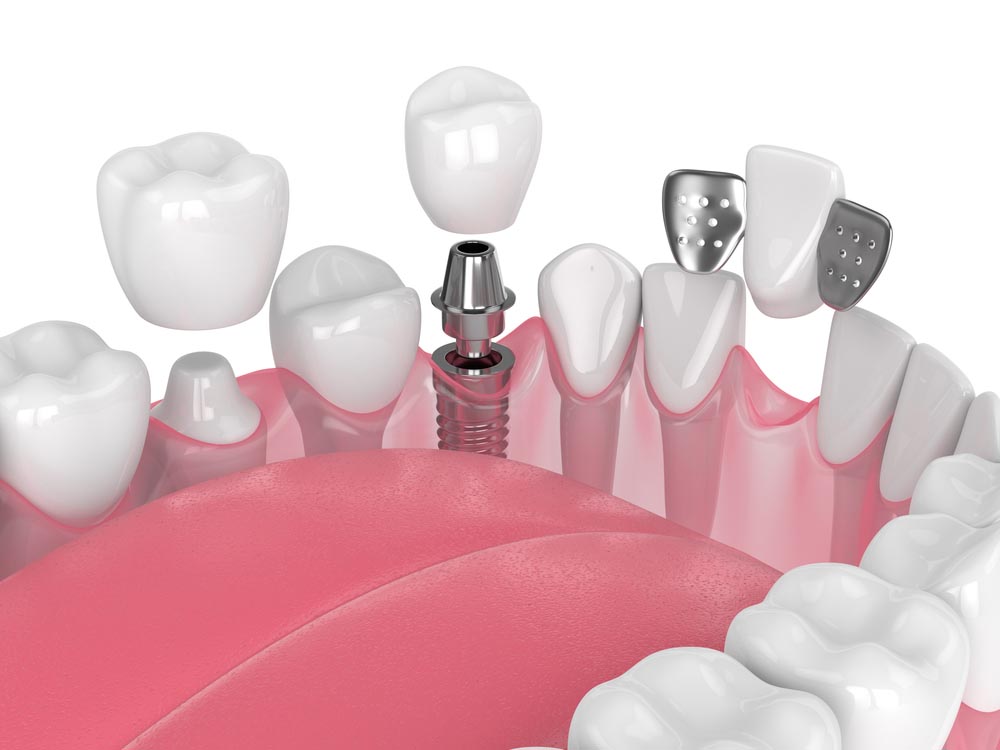3d render of jaw with dental implants and bridges over white background