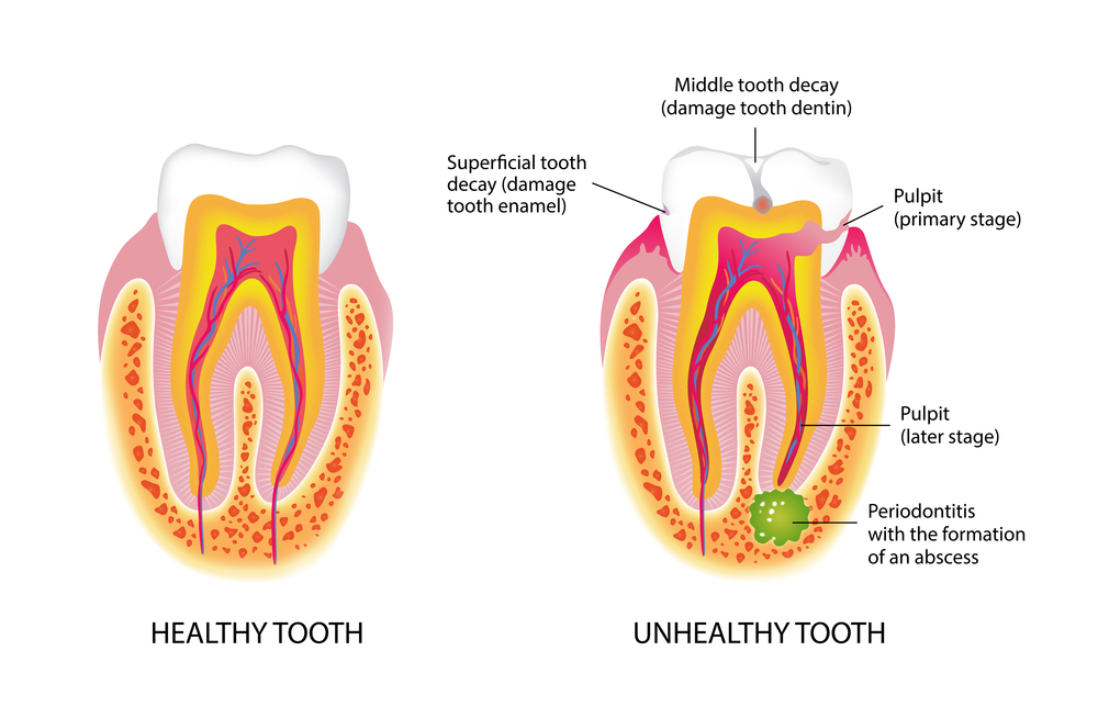 Healthy and unhealthy tooth in cross-section on a white background