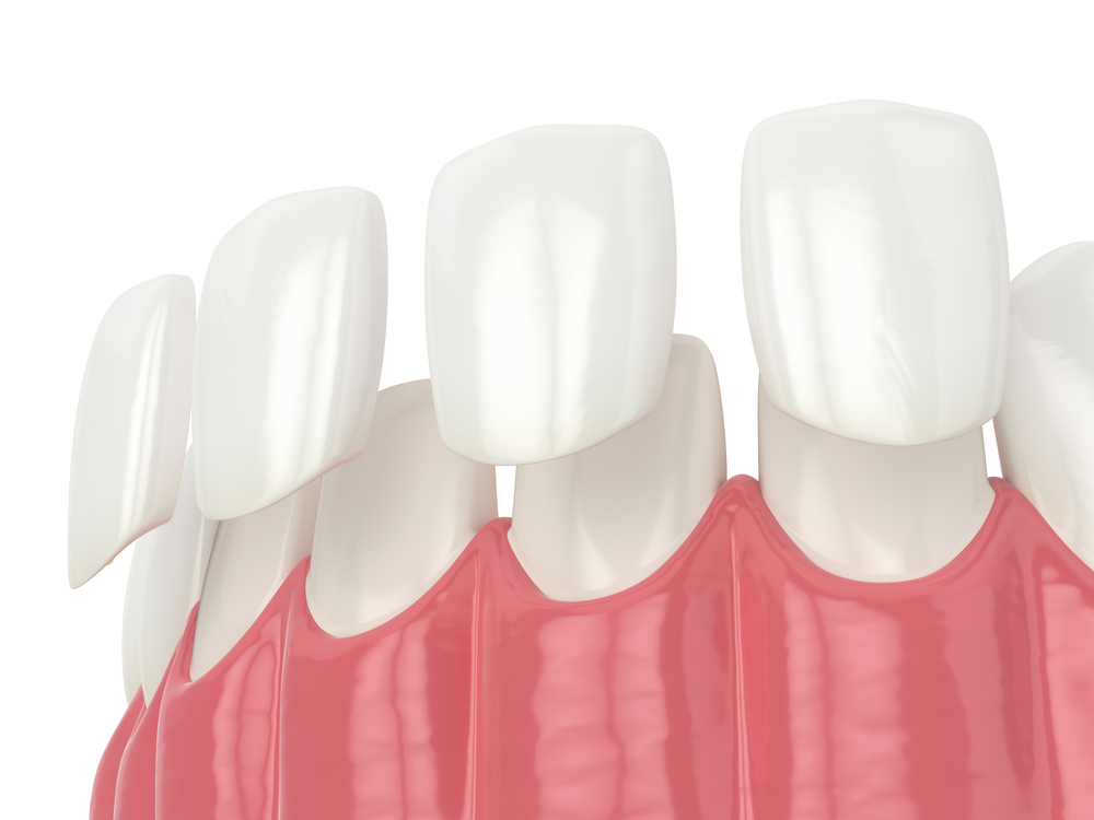 3d render of teeth with veneers over white