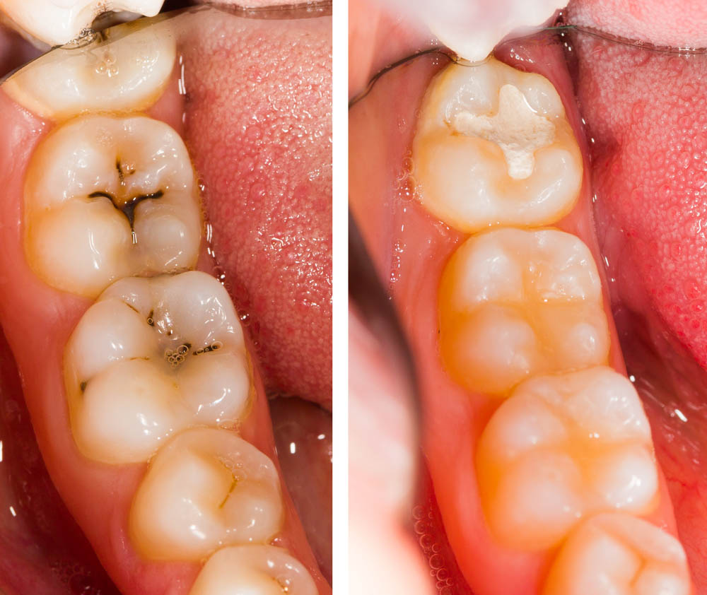 Before and after dental treatment - beforeafter series.